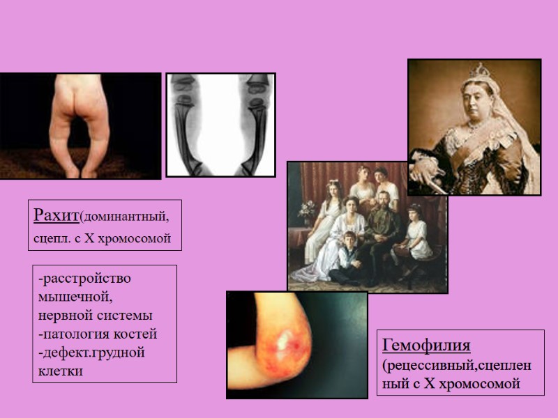 Гемофилия (рецессивный,сцепленный с Х хромосомой Рахит(доминантный, сцепл. с Х хромосомой  -расстройство мышечной, нервной